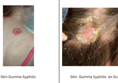 Skin & scalp Gumma Syphilis