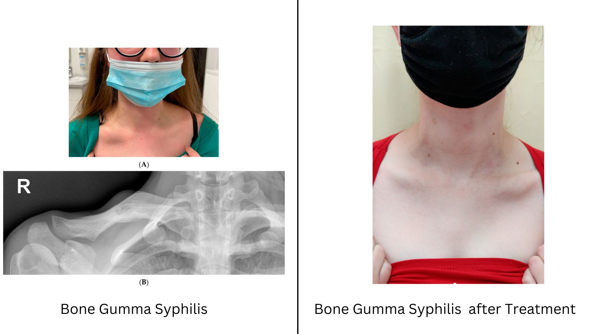 collar bone Gumma syphilis