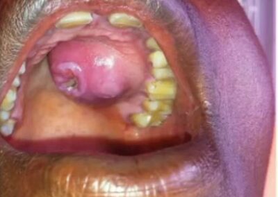 Tertiary Syphilis gummas leading to palatal perforation.