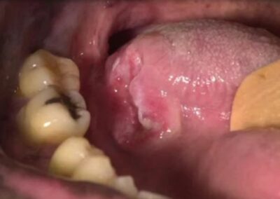 Image of Syphilis chancre on the tongue