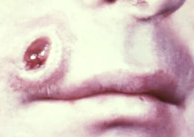 Primary syphilis chancre on the face