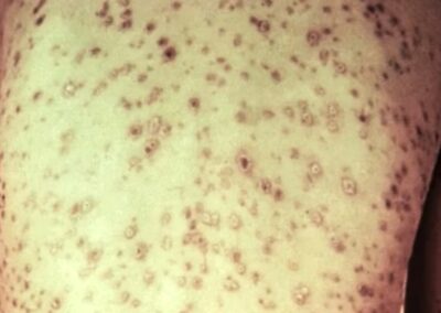 Image of Secondary syphilis on Trunk