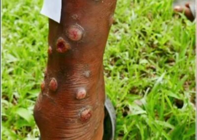 Tertiary Syphilis symptoms Gummas on the leg of a patient