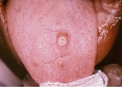 Primary syphilis chancre on the tongue