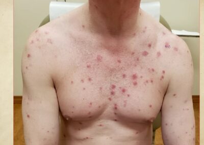 Image of Secondary syphilis lesion on chest