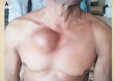 Tertiary syphilis-symptom-aortic-aneurysm-syphilis