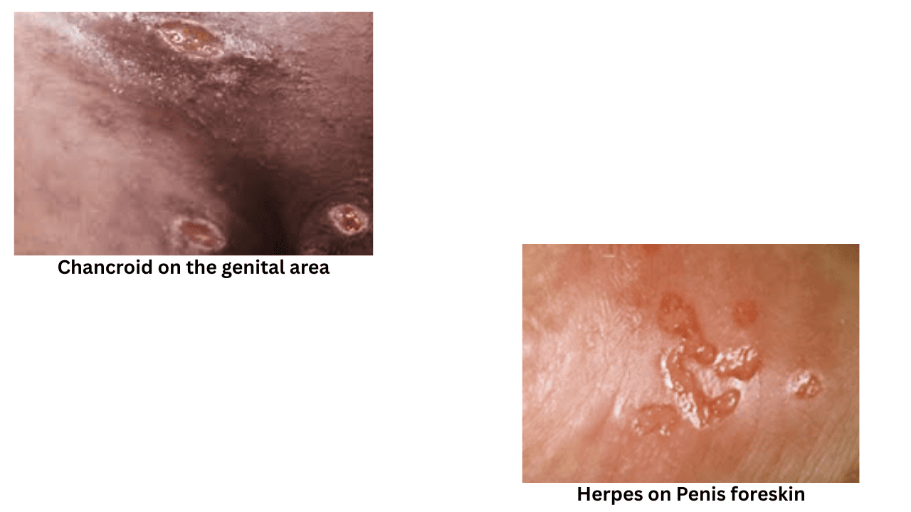Chancroid vs genital herpes penis