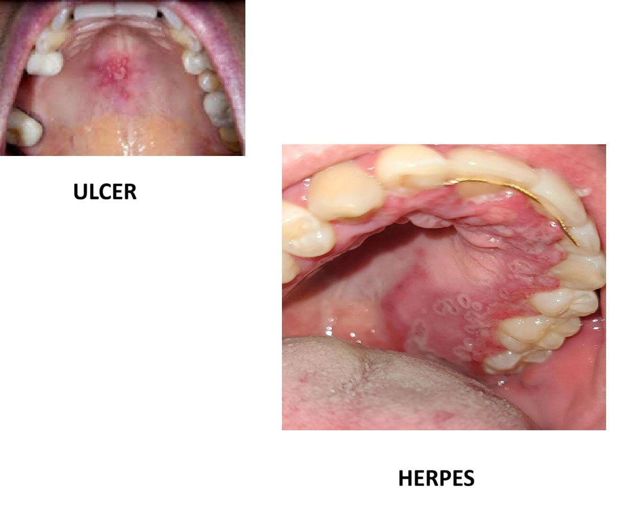 HERPES VS ULCER MOUTH ROOF