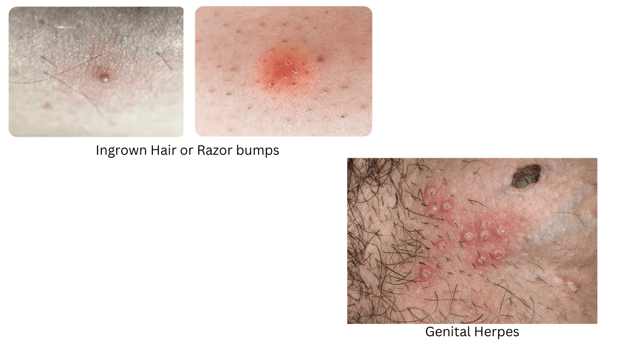 Ingrown Hair or Razor bumps