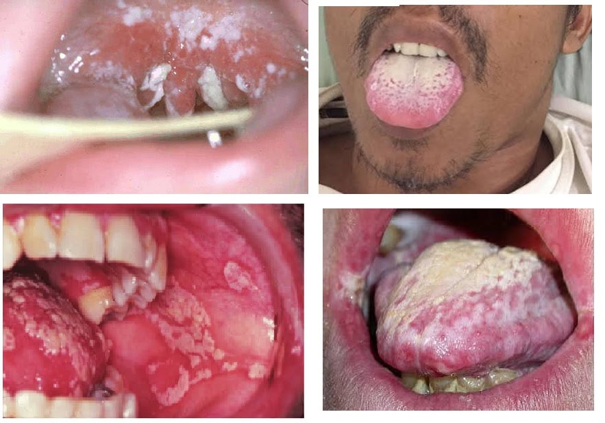 Candidal Infections Thrush in HIV affect the mouth tongue esophagus