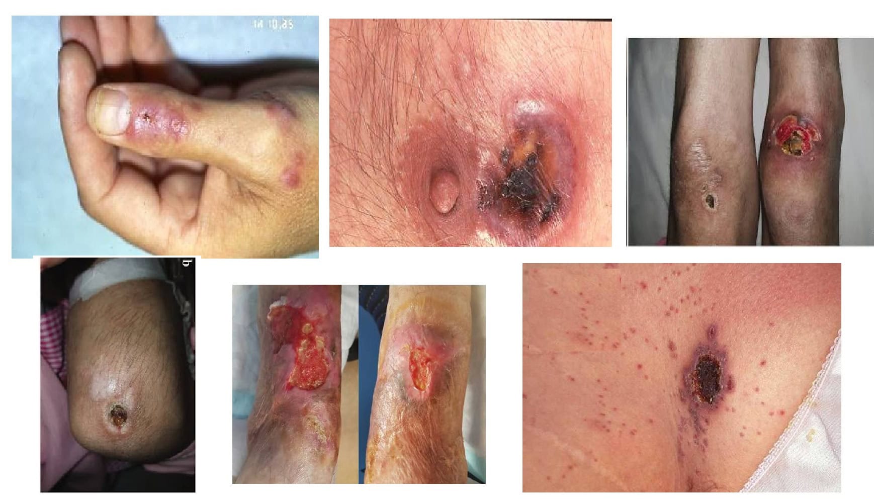 Cytomegalovirus (CMV)  due to hiv A systemic viral infection that can also have cutaneous (skin) manifestations
