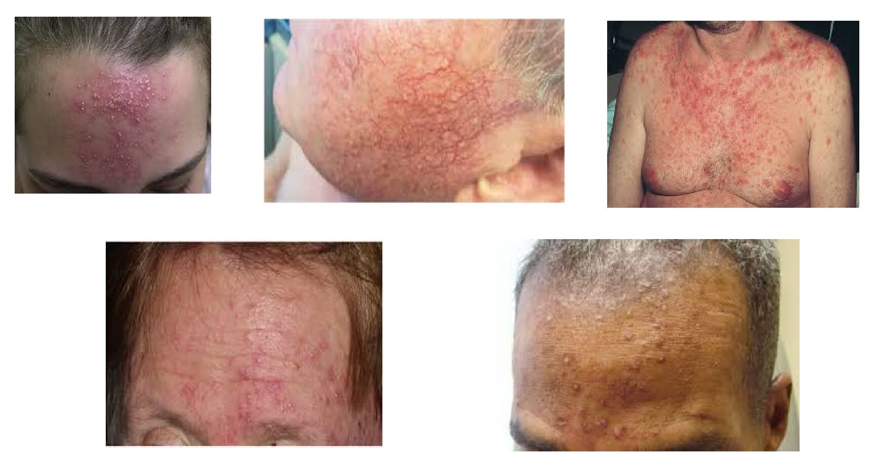 Demodex-Folliculitis-due-to hiv on forehead 