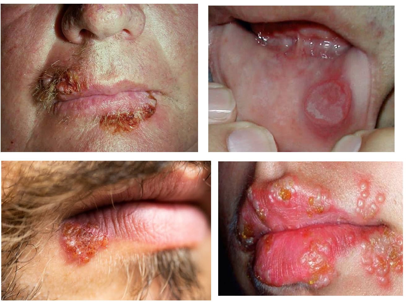 Herpes Simplex in HIV May present as persistent, painful ulcerated lesions