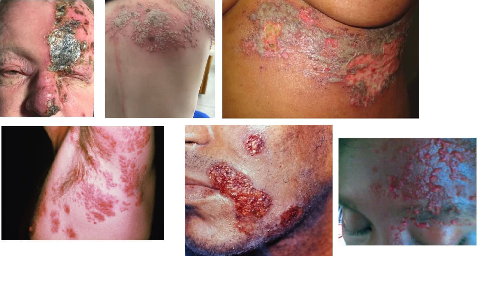 Herpes Zoster (Shingles): Patients may experience recurrent or chronic outbreaks on mouth underarms nose skin