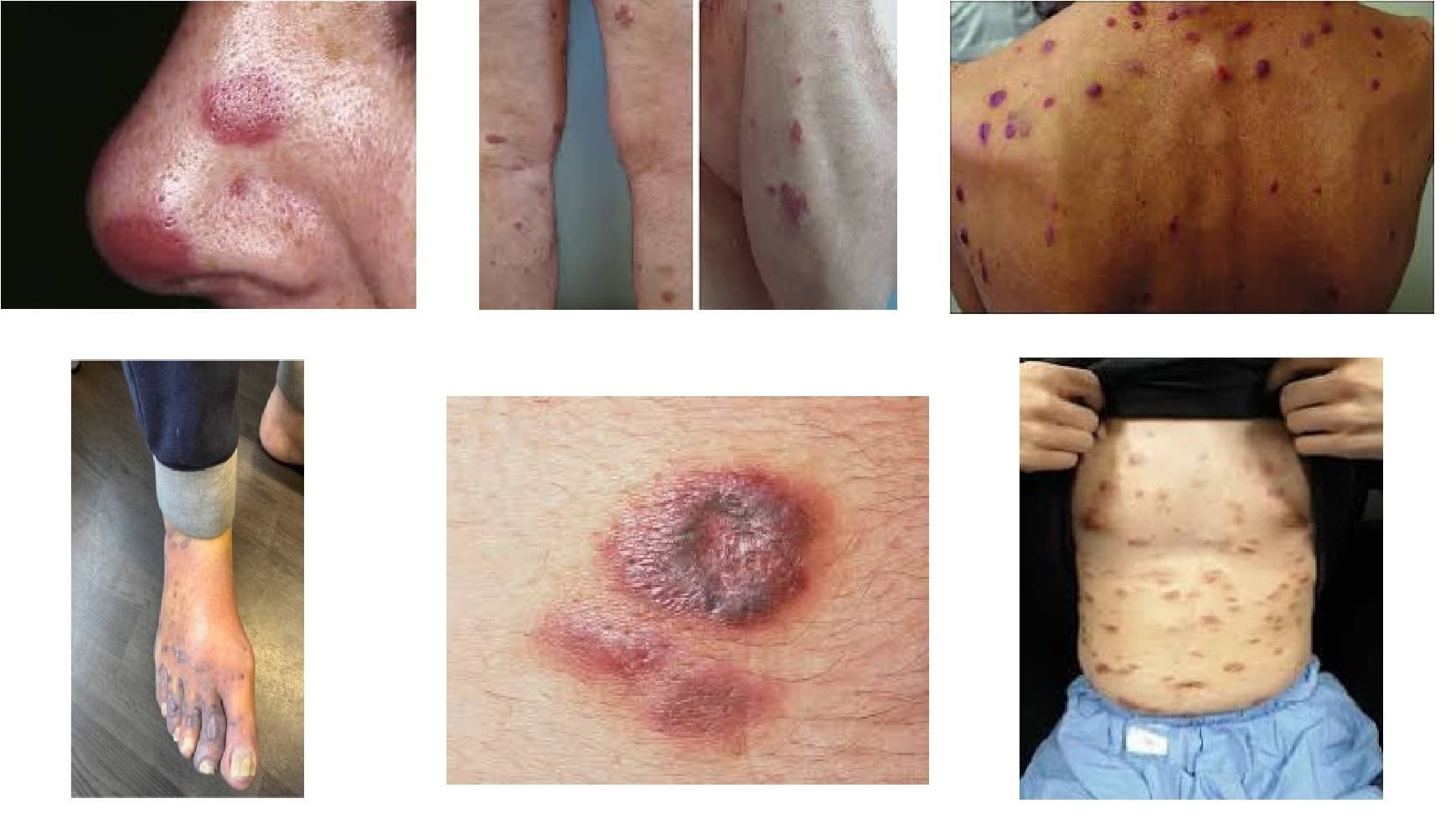 Kaposi Sarcoma due to HIV