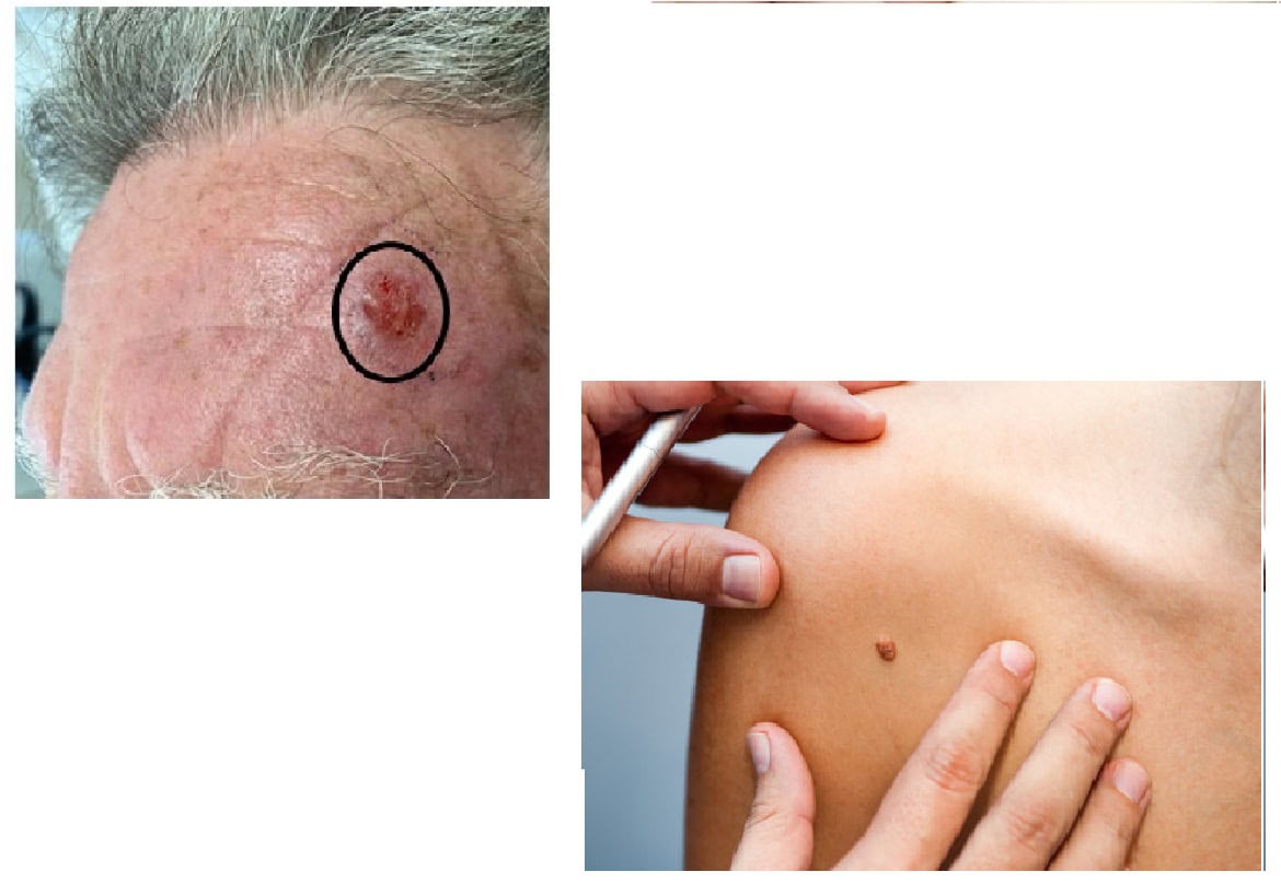 Melanoma due to hiv