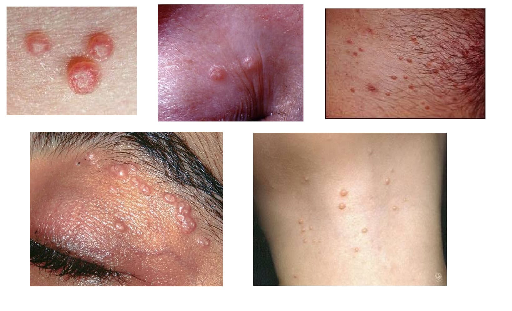 Molluscum Contagiosum due to hiv Presents as small, raised, pearl-like bumps on the skin