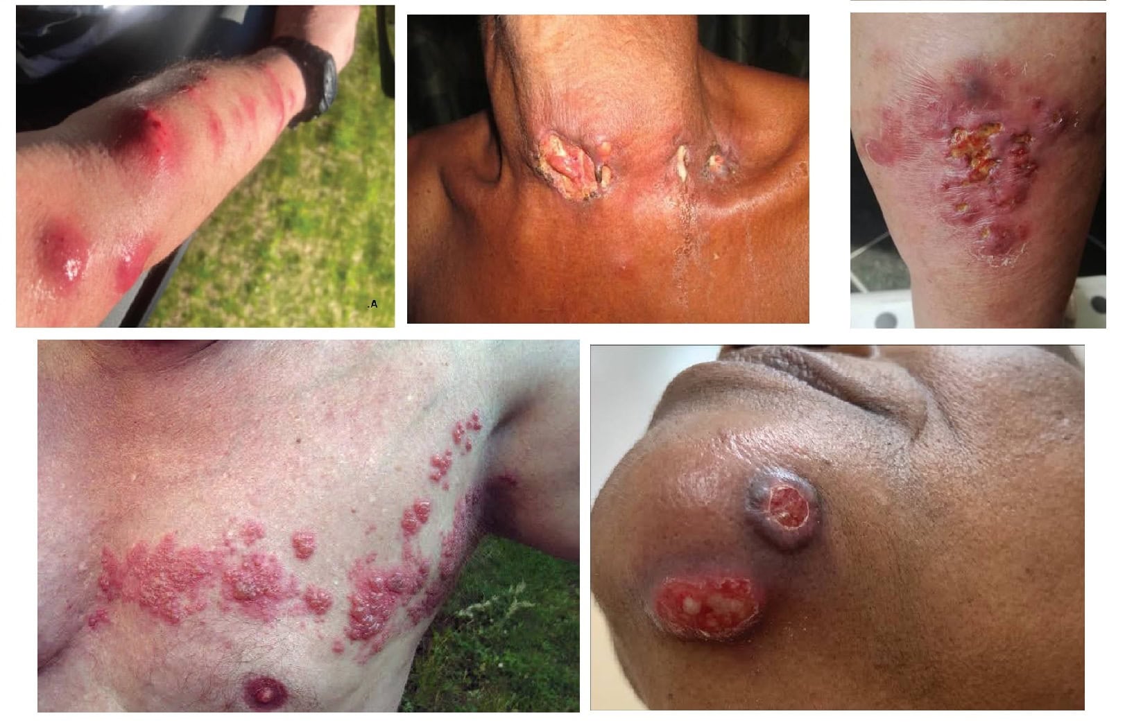 Mycobacterial Infections These can cause chronic, difficult-to-treat skin lesions