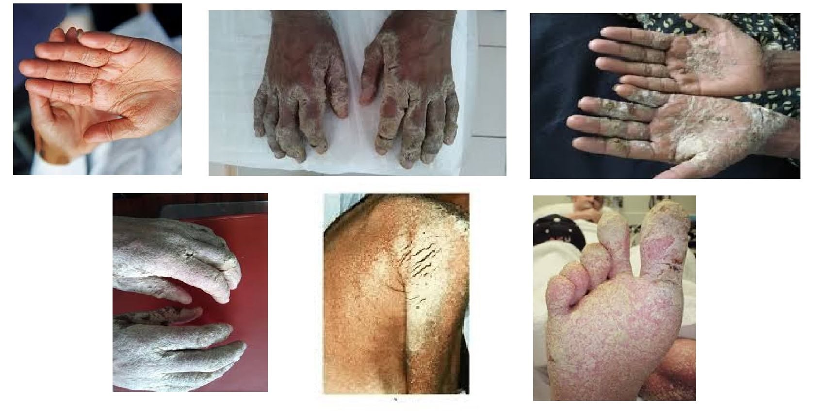 An inflammatory condition caused by an overgrowth of Demodex mites in the hair follicles. Norwegian-Scabies-due-to-hiv-A-highly-contagious-severe-and-crusted-form-of-standard-scabies
