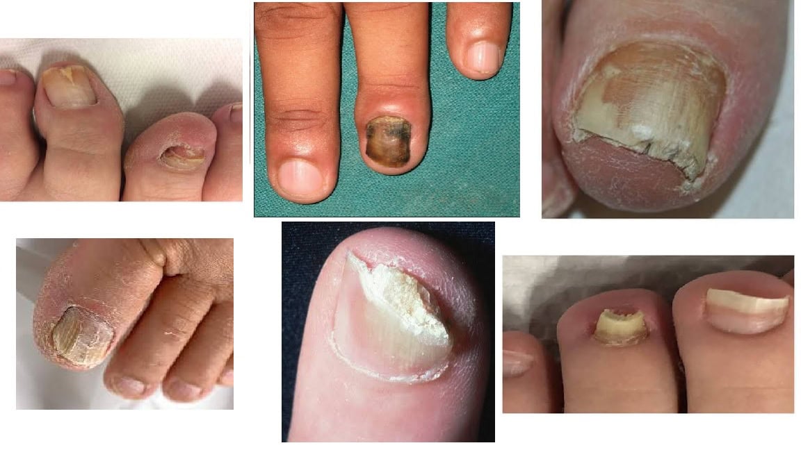 Onychomycosis fungal infection in HIV that targets the nails