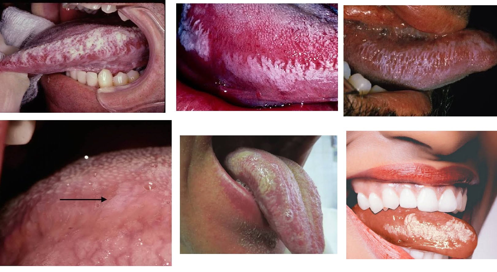 Oral Hairy leukoplakia tongue due to hiv