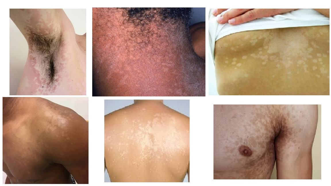Pityriasis Versicolor in HIV A fungal issue that causes noticeable hyperpigmented (darker) or hypopigmented (lighter) patches or lesions over the skin