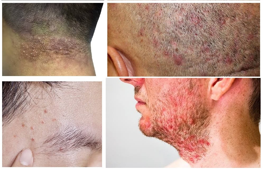 Pityrosporum Folliculitis in HIV This condition causes an acne-like inflammation centered around the hair follicles.