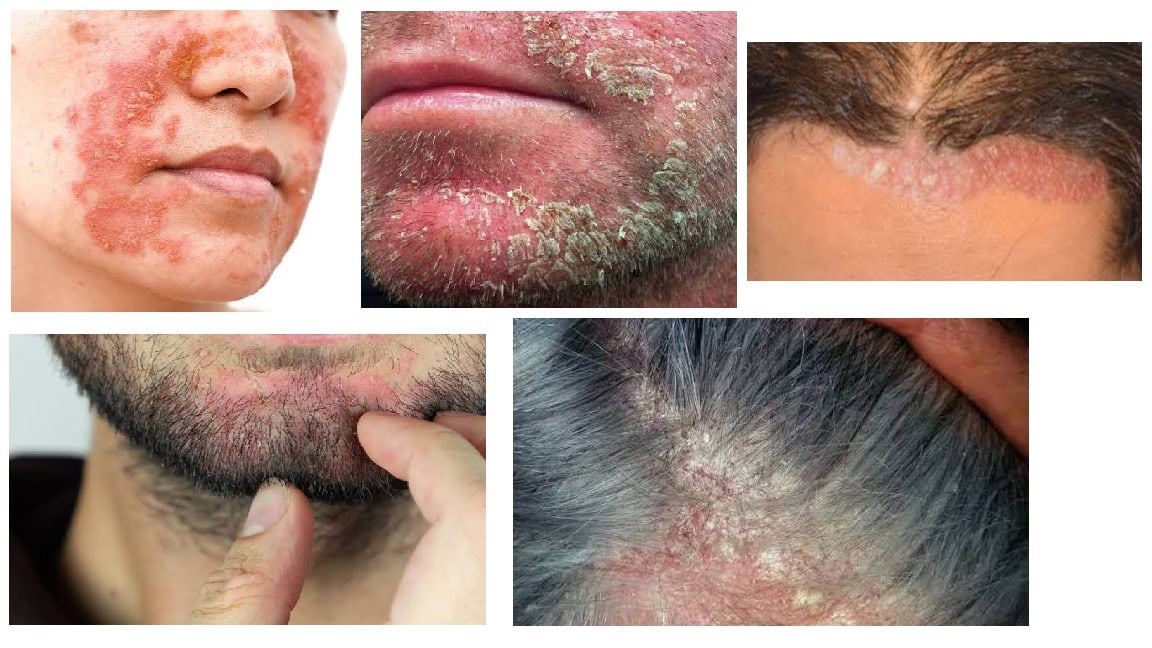 Seborrheic Dermatitis: A common inflammatory scaling disease that is heavily associated with HIV.