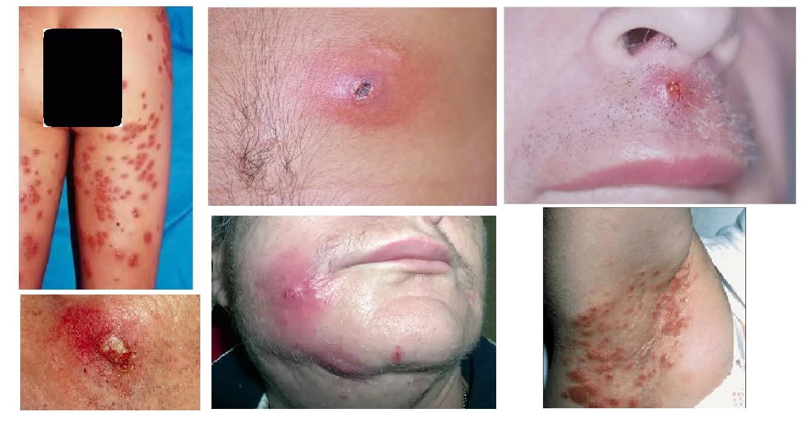 Staphylococcus Aureus due to hiv ads to issues like folliculitis, impetigo, and painful skin abscesses on face back underarms