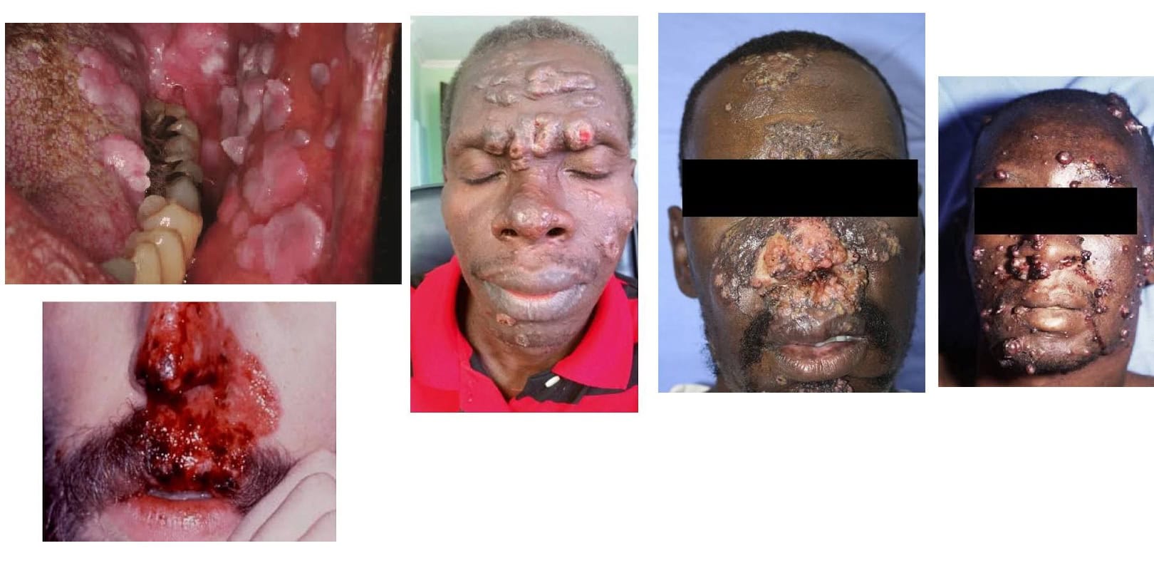 Viral Warts in HIV hyperkeratotic (thickened) highly proliferative spreading rapidly