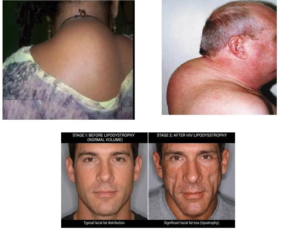 lipodystrophy hiv pictures