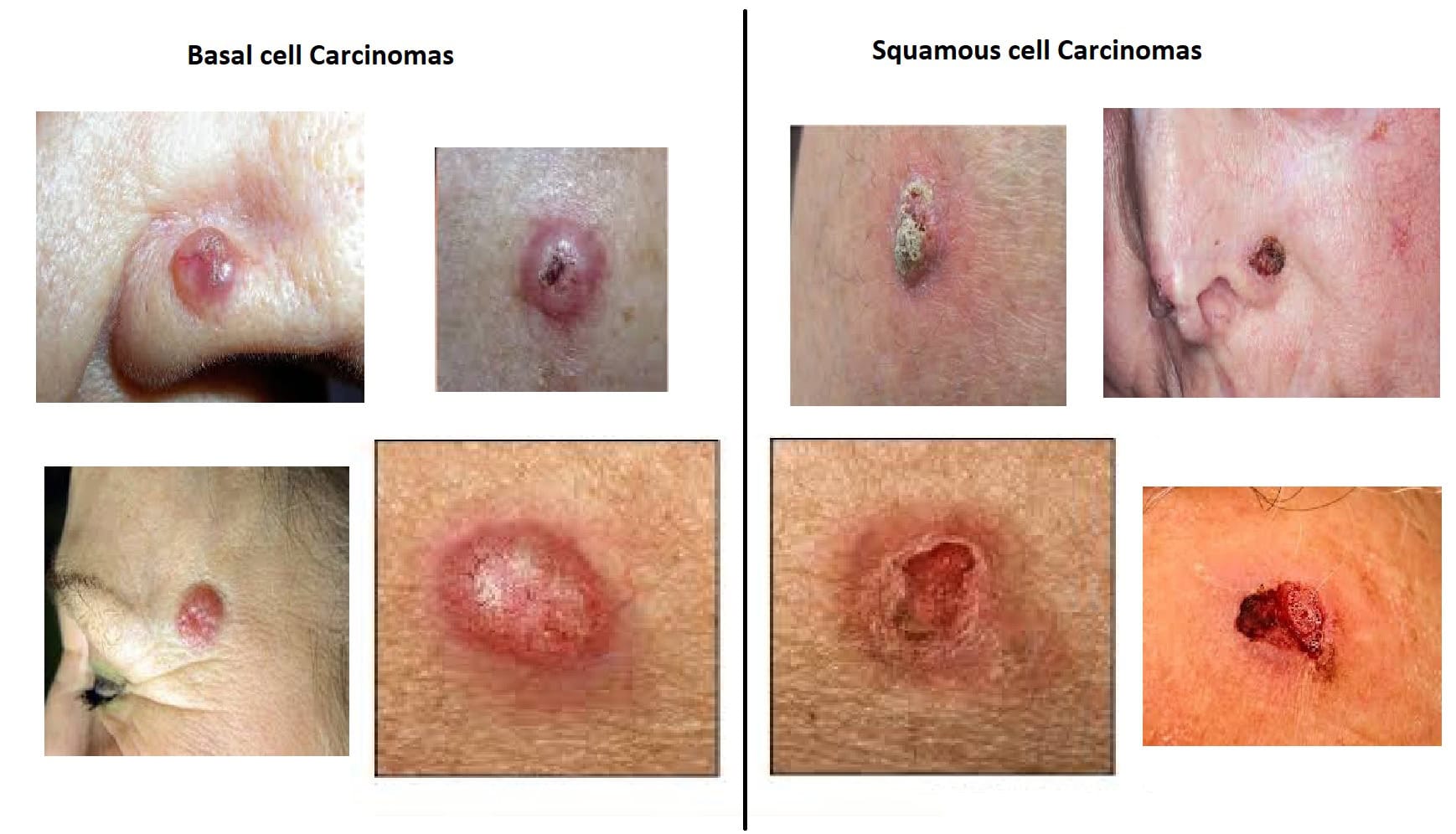 squamous cell carcinomas and basal cell carcinomas due to hiv